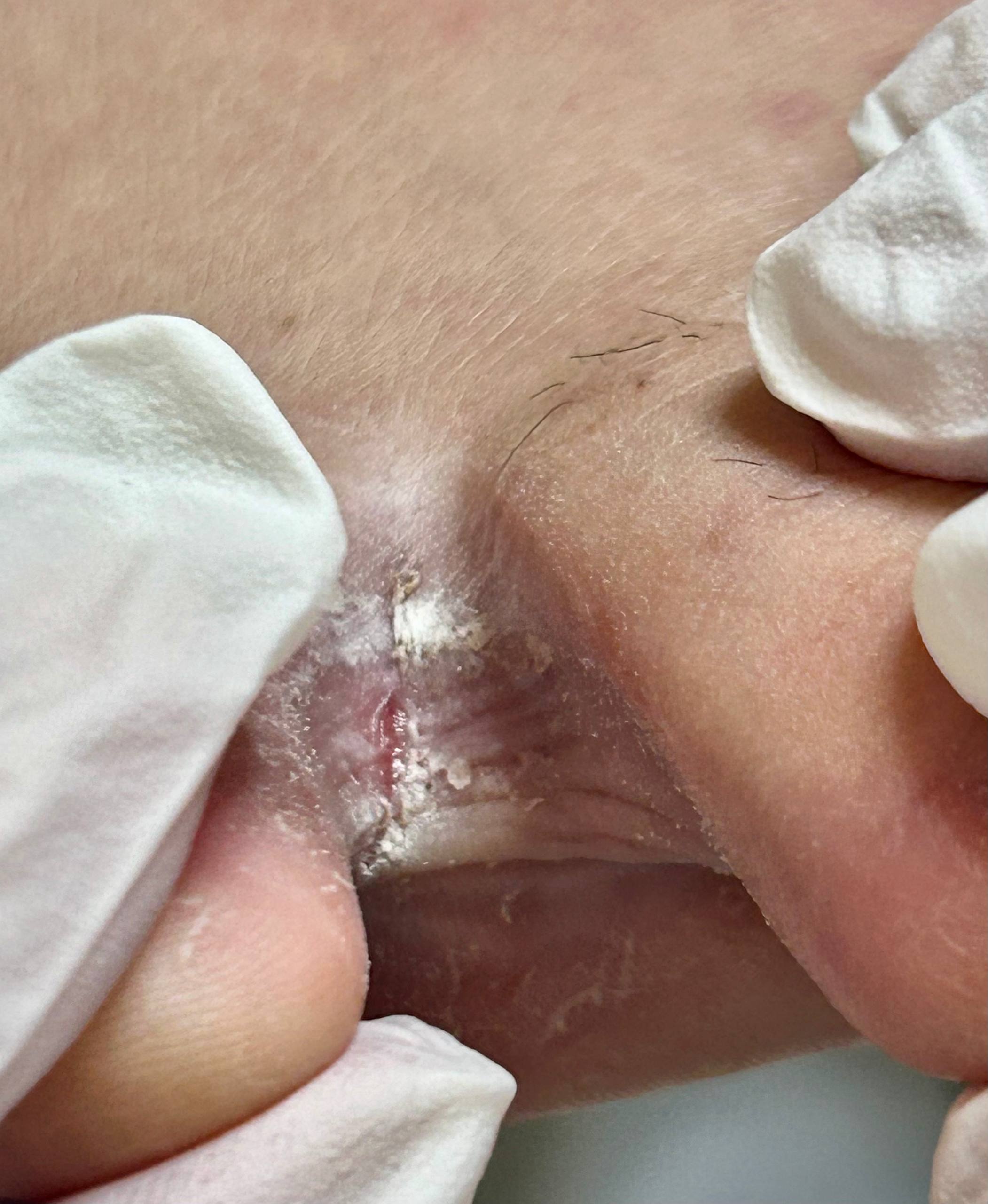 Пример микоза стопы