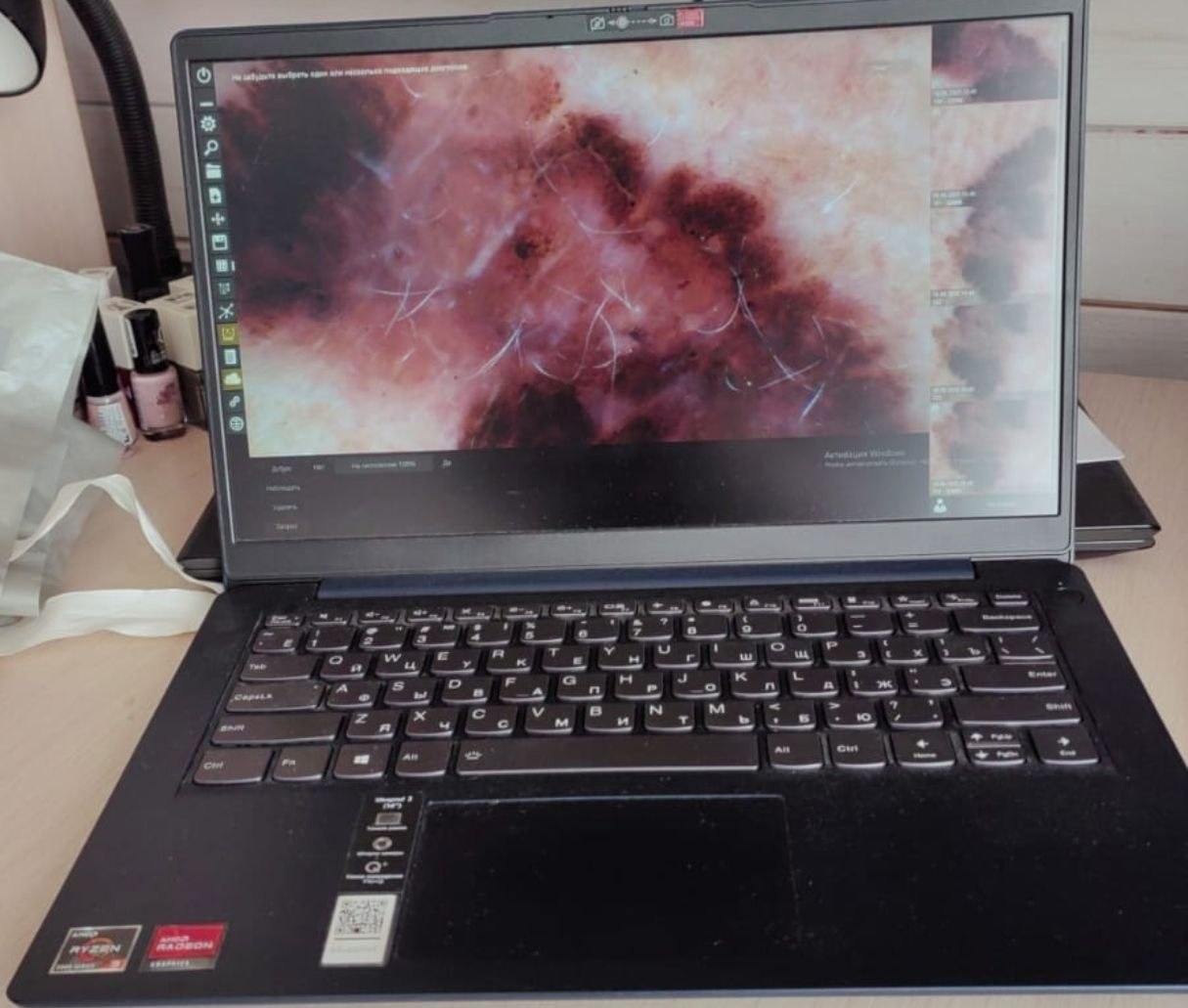 Анализ дерматоскопических снимков на рабочей станции