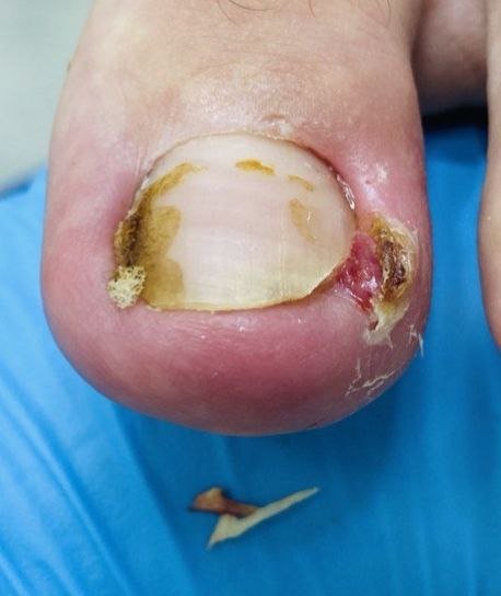 До лечения Вросший ноготь