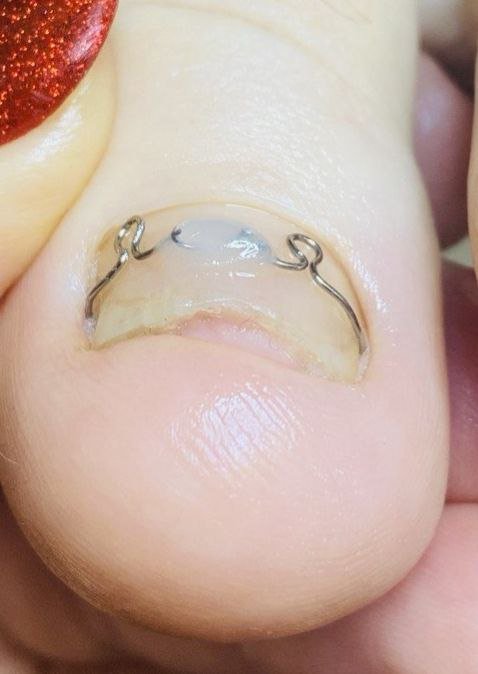 После лечения Корректирующие системы