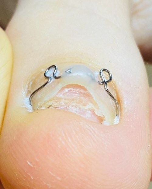 До лечения Корректирующие системы